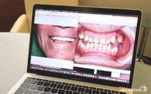 Dentista Antequera. Implantes dentales en un día.