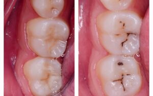 Clínica dental Antequera. Tratamiento de caries en Antequera