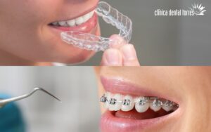 Brackets Vs Ortodoncia transparente (alineadores)