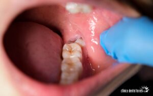 clinica dental antequera. Muelas del jucio cuando quitarlas